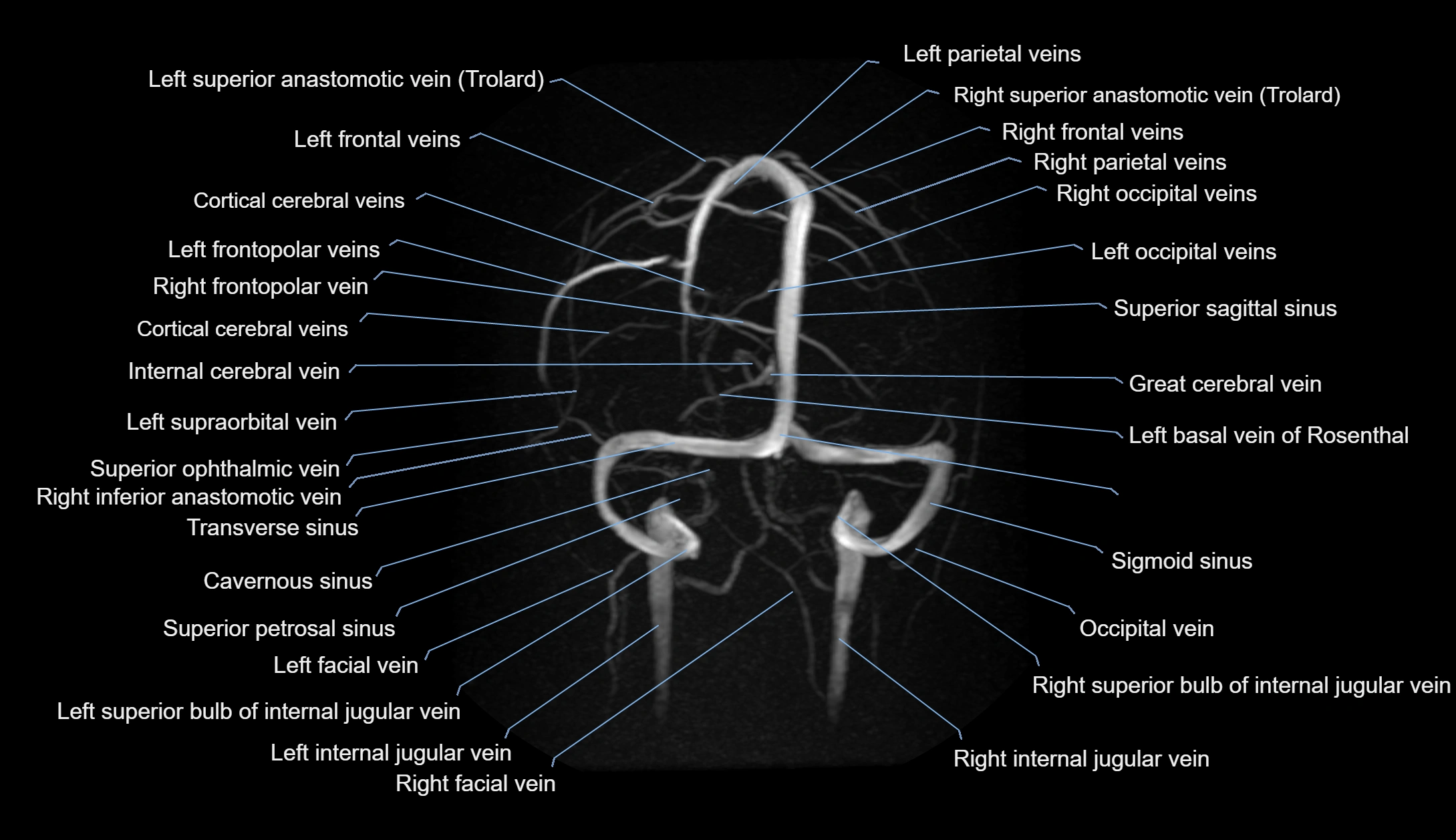 MRV brain MIP sagittal labelled anatomy 3T MRI images -img-1011001-00010.webp